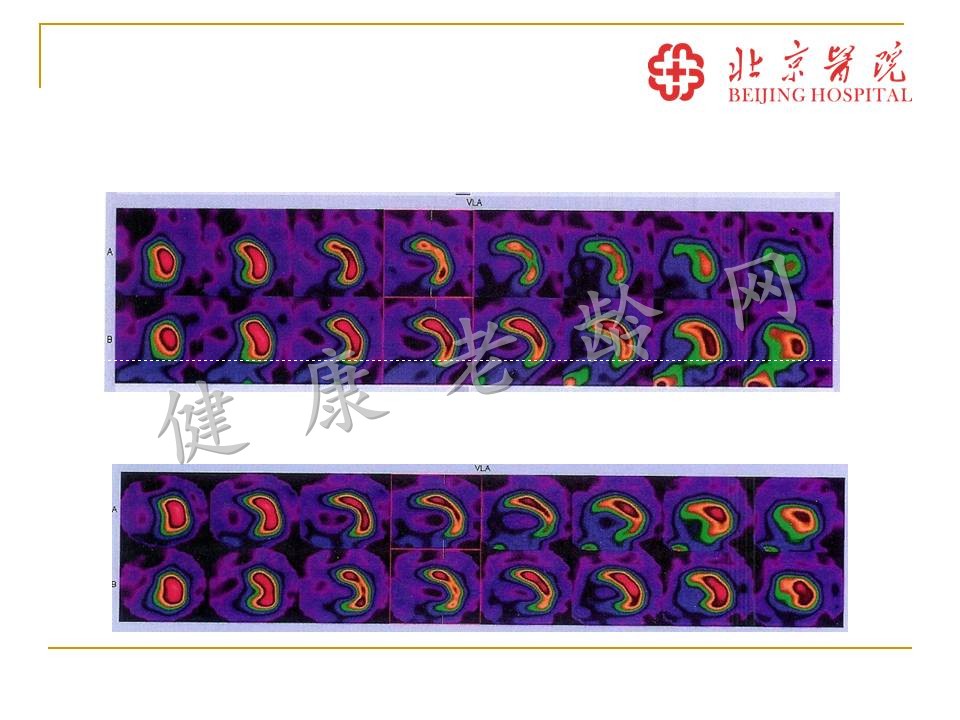 体外心脏振波治疗顽固性冠心病