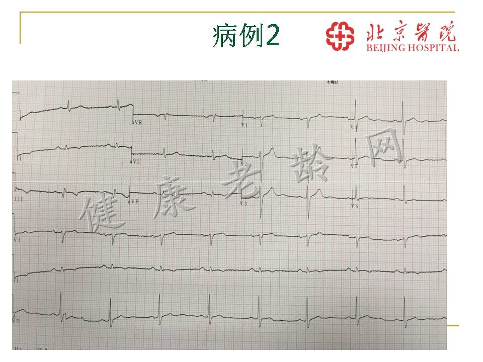 体外心脏振波治疗顽固性冠心病