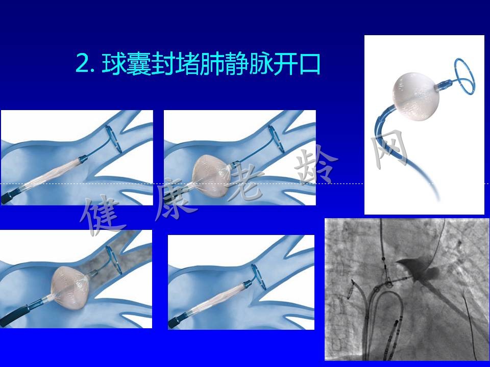 老年房颤患者的治疗