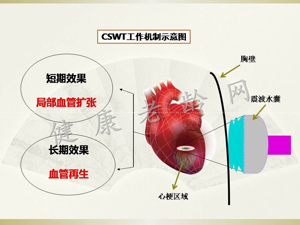 冠心病治疗新方法探讨——体外心脏震波治疗 Cardiac Shock Wave Therapy