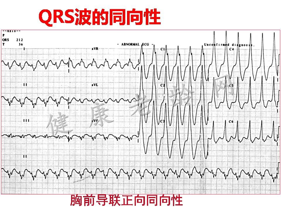 宽QRS波心动过速的鉴别