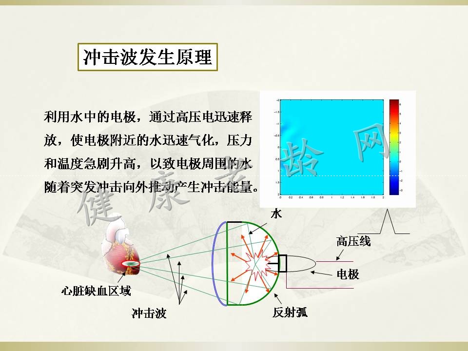 冠心病治疗新方法探讨——体外心脏震波治疗 Cardiac Shock Wave Therapy