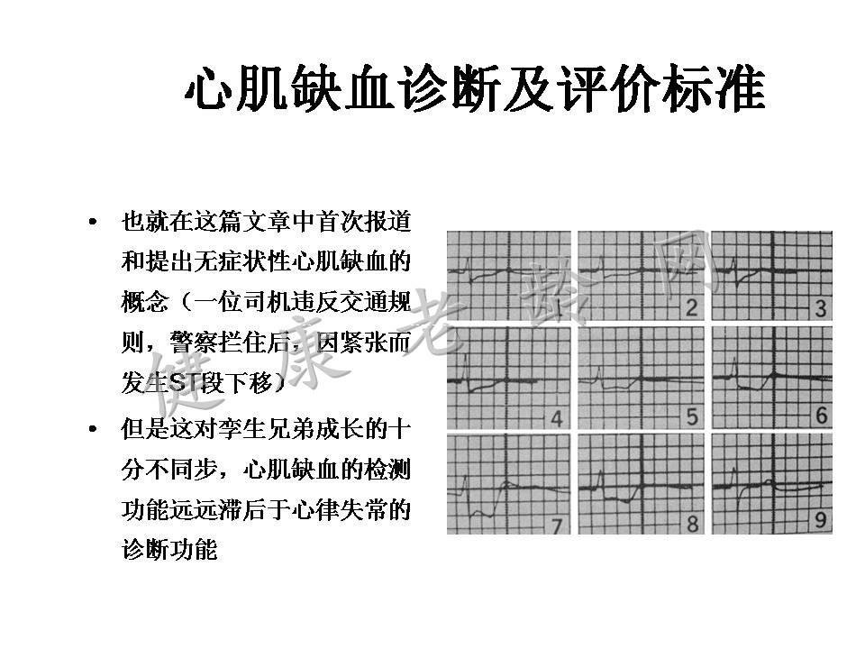 动态心电图