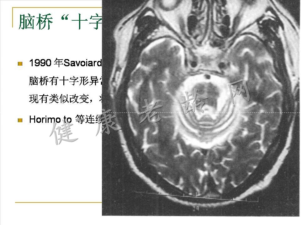 严重直立性低血压一例