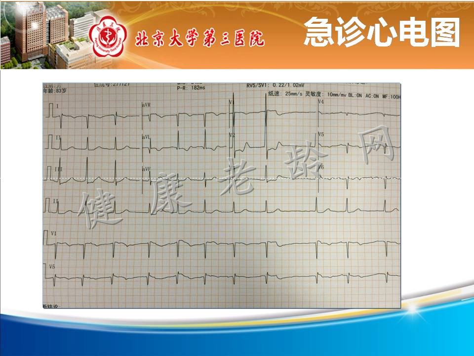 高龄横纹肌溶解并多脏器功能衰竭一例