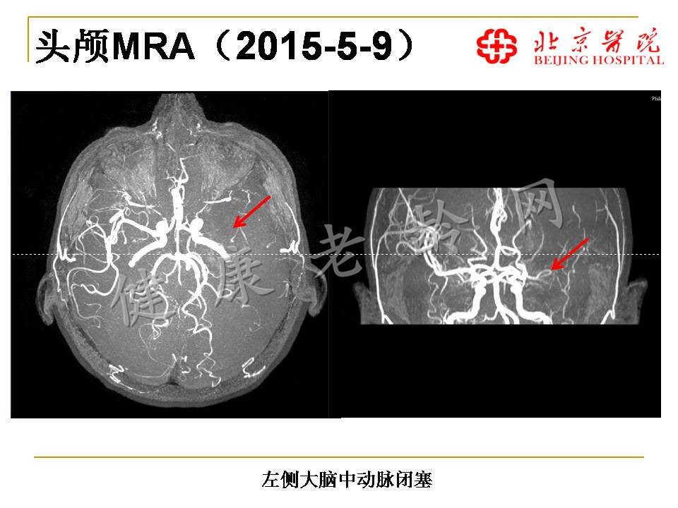 特殊表现的感染性心内膜炎一例