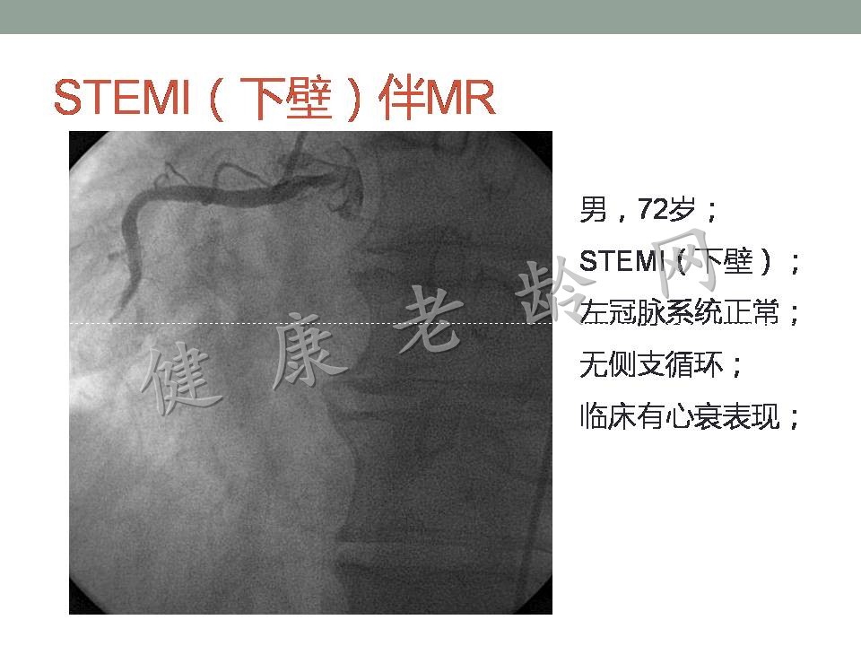 老年人急性心肌梗死并发症的诊治