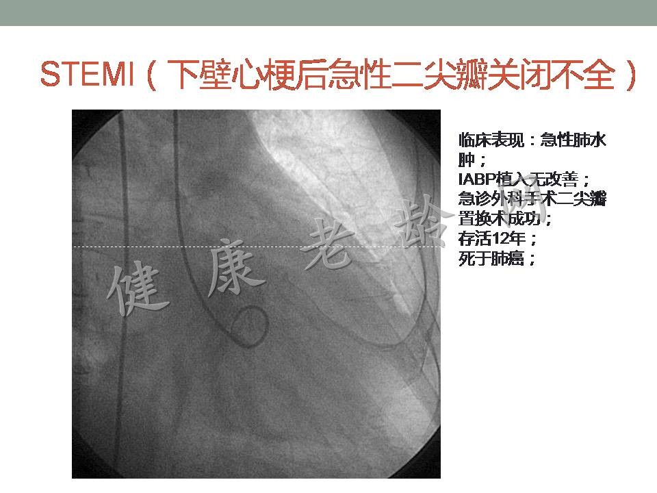 老年人急性心肌梗死并发症的诊治