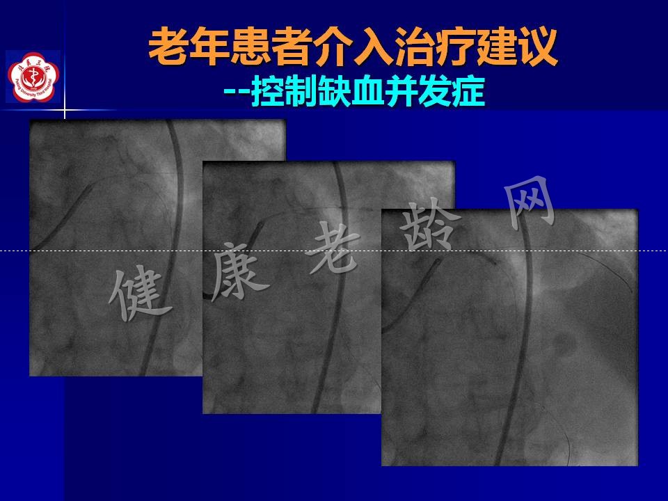 高龄冠心病患者介入治疗——问题思考