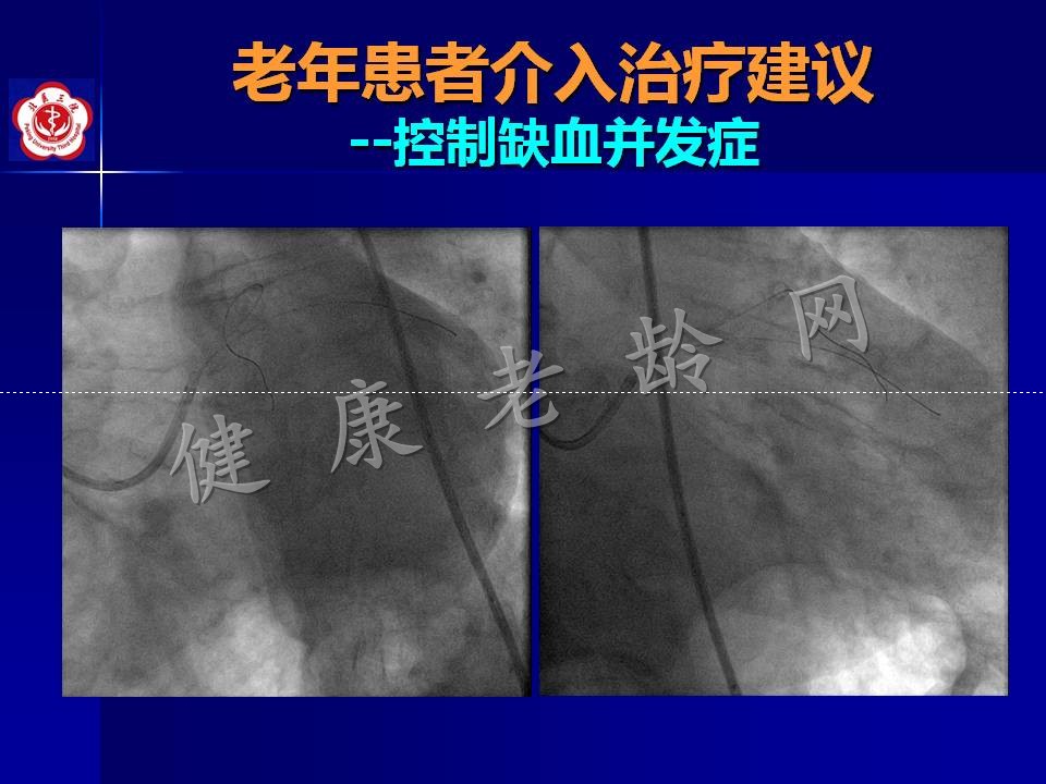 高龄冠心病患者介入治疗——问题思考