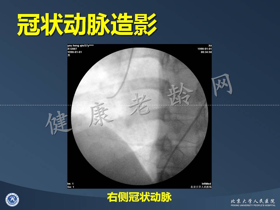 真实病因被忽视的急性心肌梗死