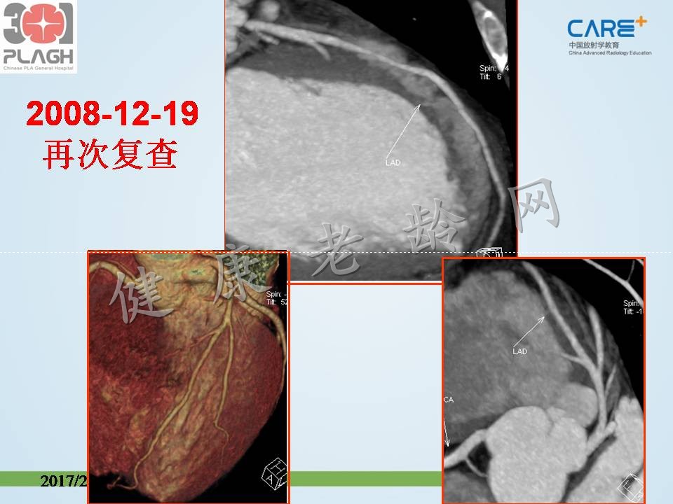 心脏、冠状动脉CT检查（CTA）：判读与意义