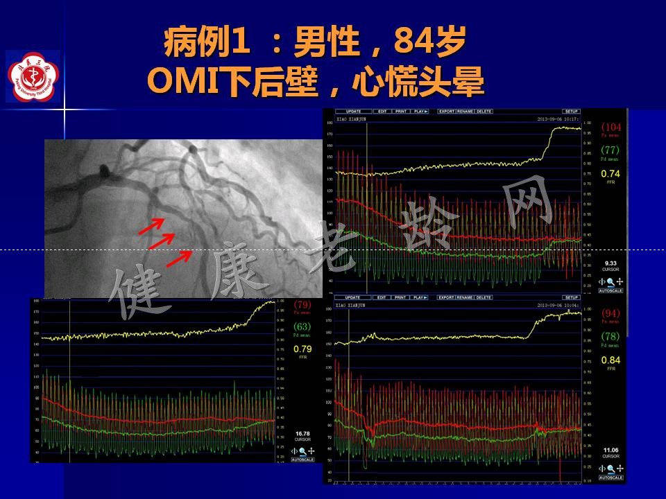 高龄冠心病患者介入治疗——问题思考