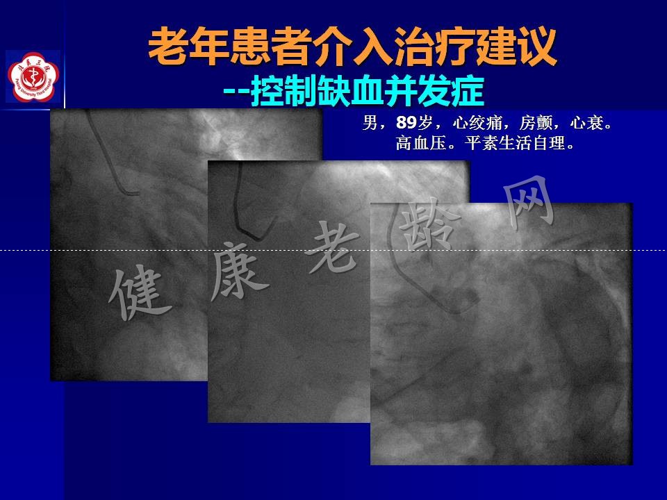 高龄冠心病患者介入治疗——问题思考