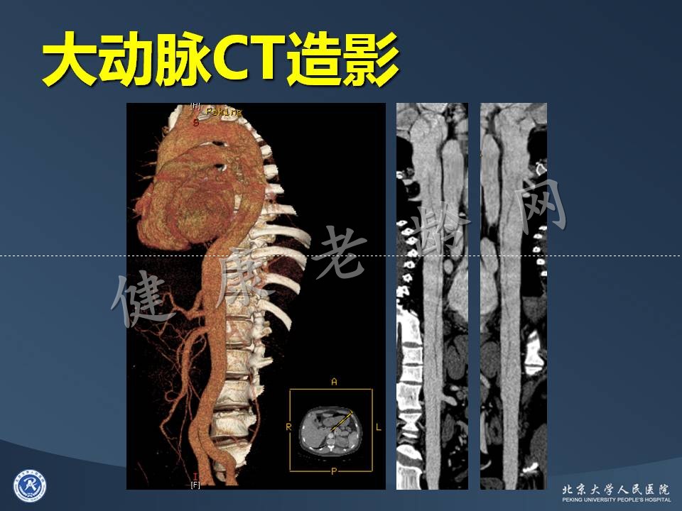 真实病因被忽视的急性心肌梗死