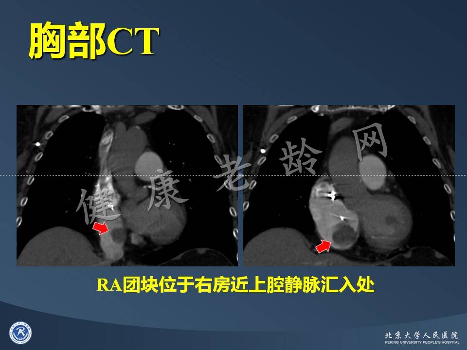 心房占位的诊断困境
