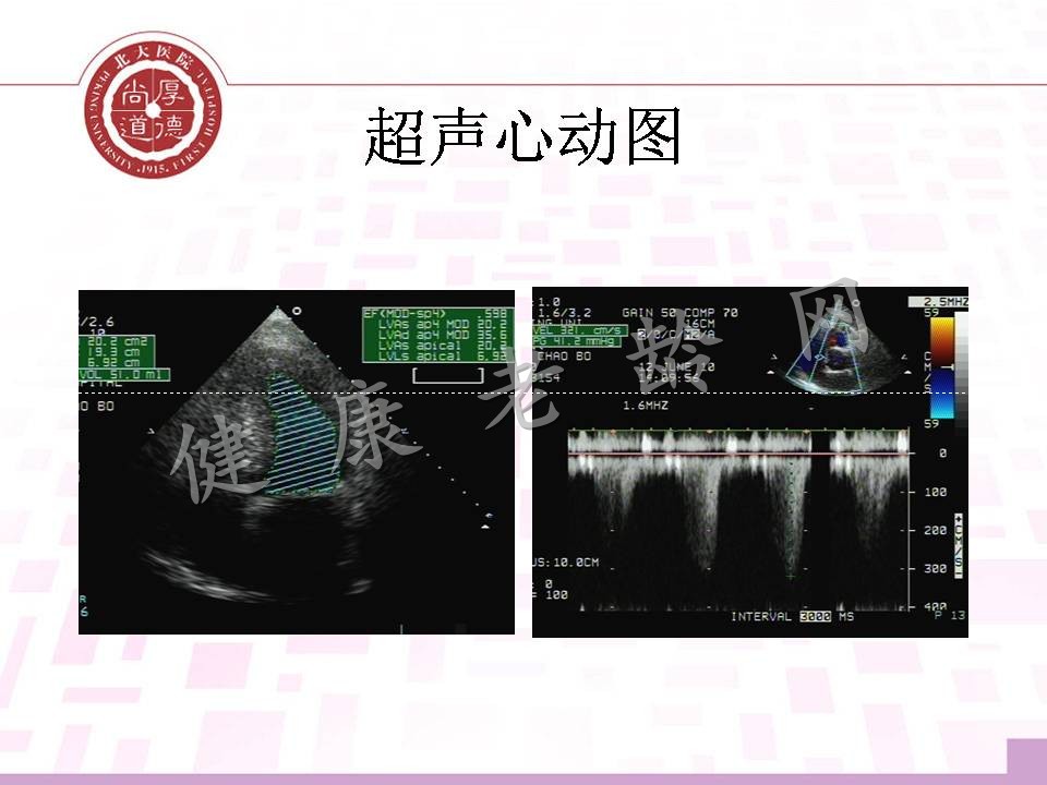 老年高血压、冠心病合并瓣膜病心力衰竭患者的治疗思路