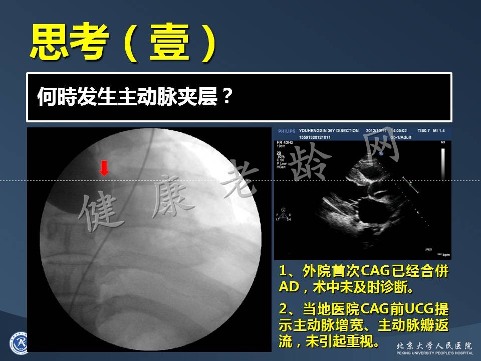 真实病因被忽视的急性心肌梗死