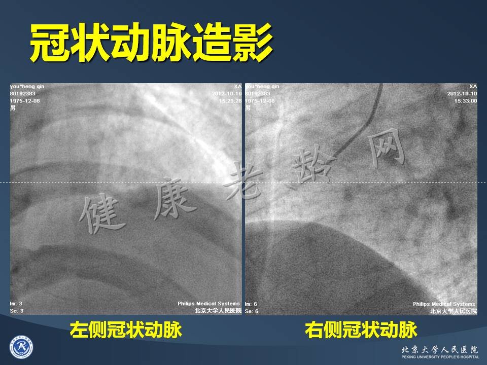 真实病因被忽视的急性心肌梗死