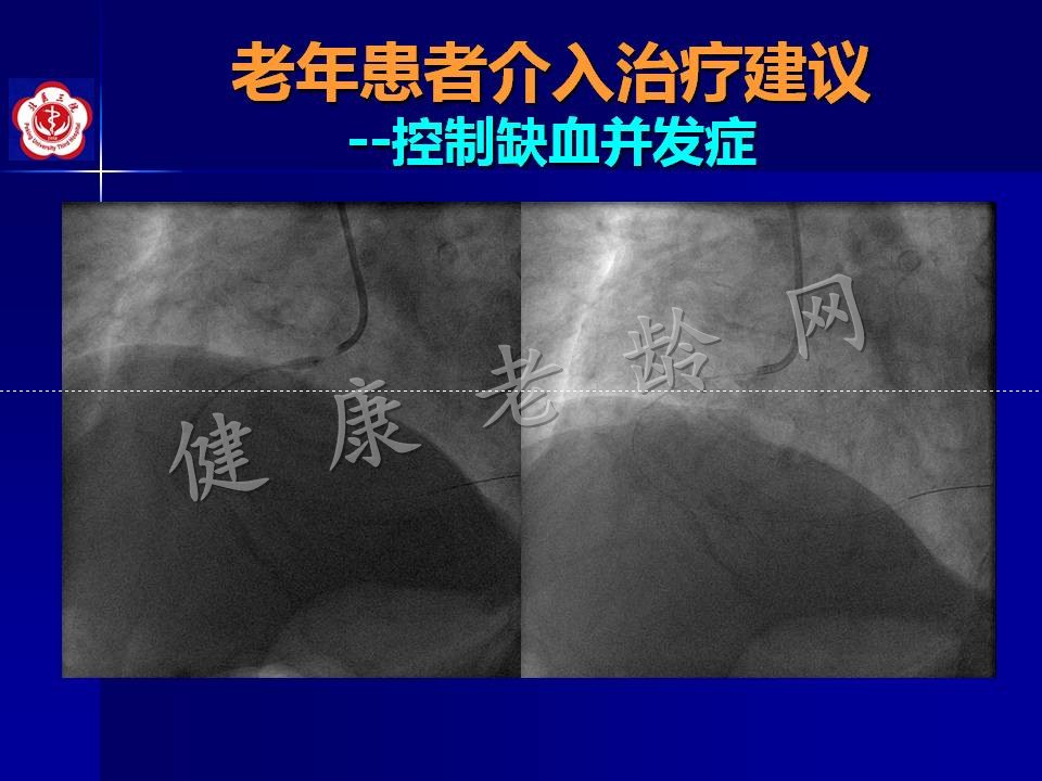 高龄冠心病患者介入治疗——问题思考