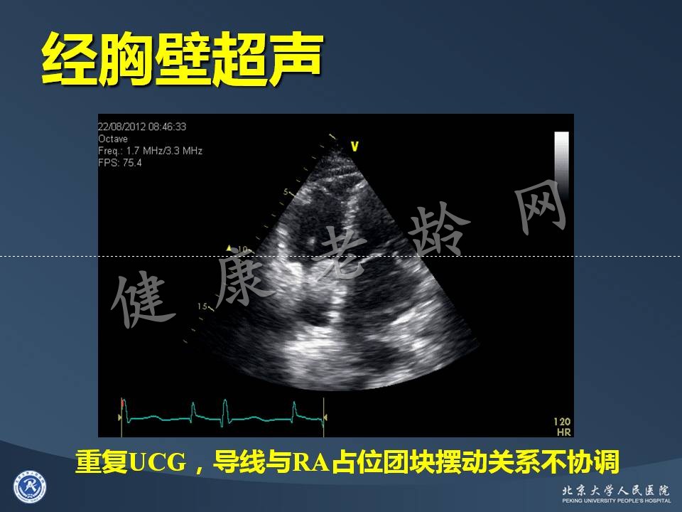 心房占位的诊断困境