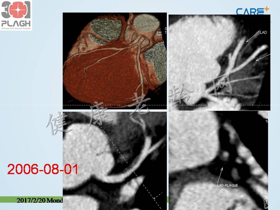 心脏、冠状动脉CT检查（CTA）：判读与意义