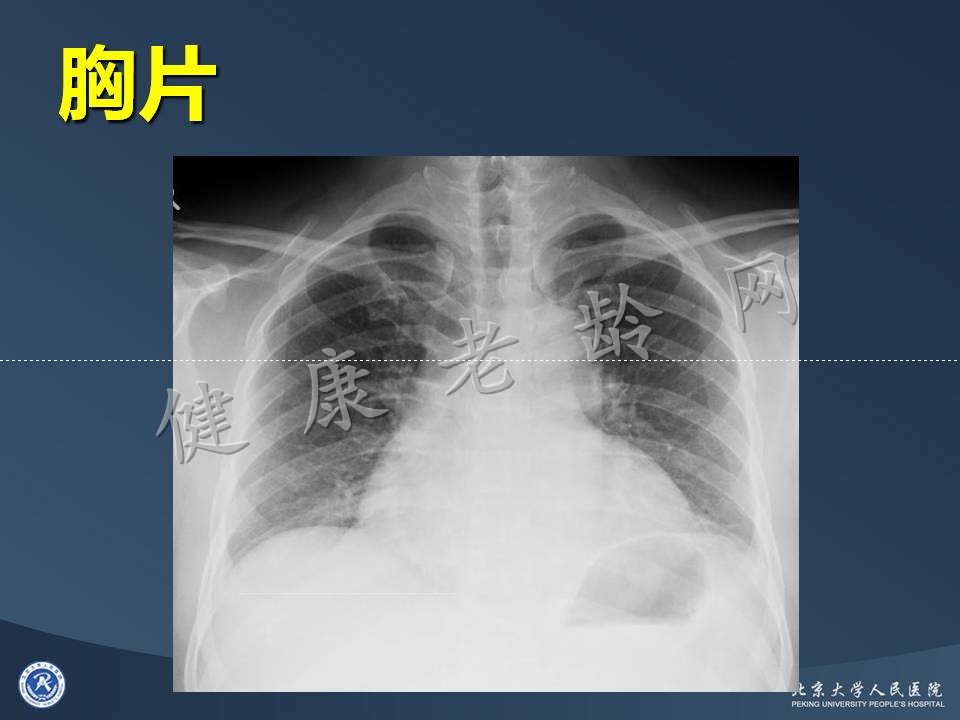 真实病因被忽视的急性心肌梗死