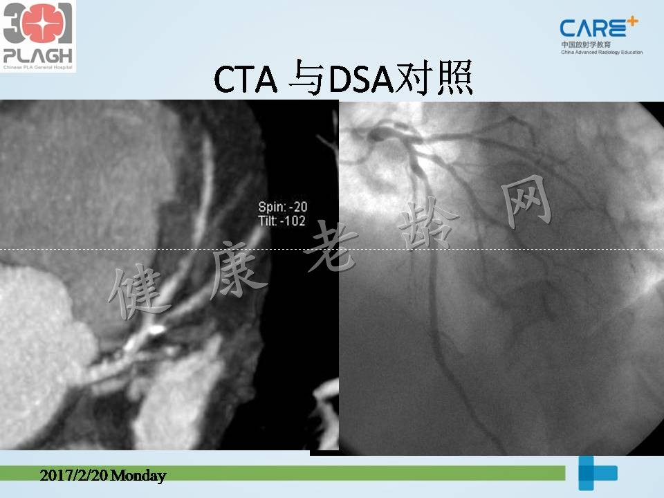 心脏、冠状动脉CT检查（CTA）：判读与意义