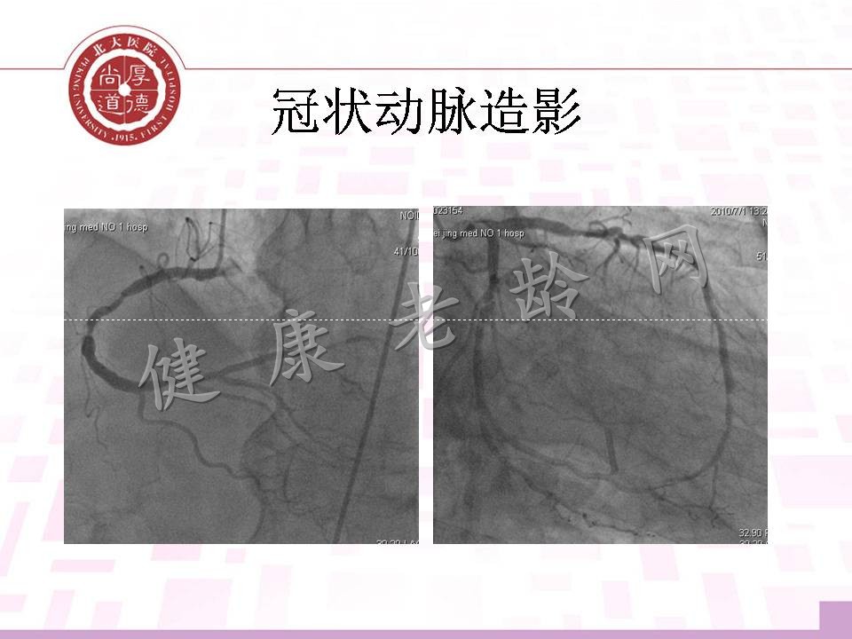 老年高血压、冠心病合并瓣膜病心力衰竭患者的治疗思路