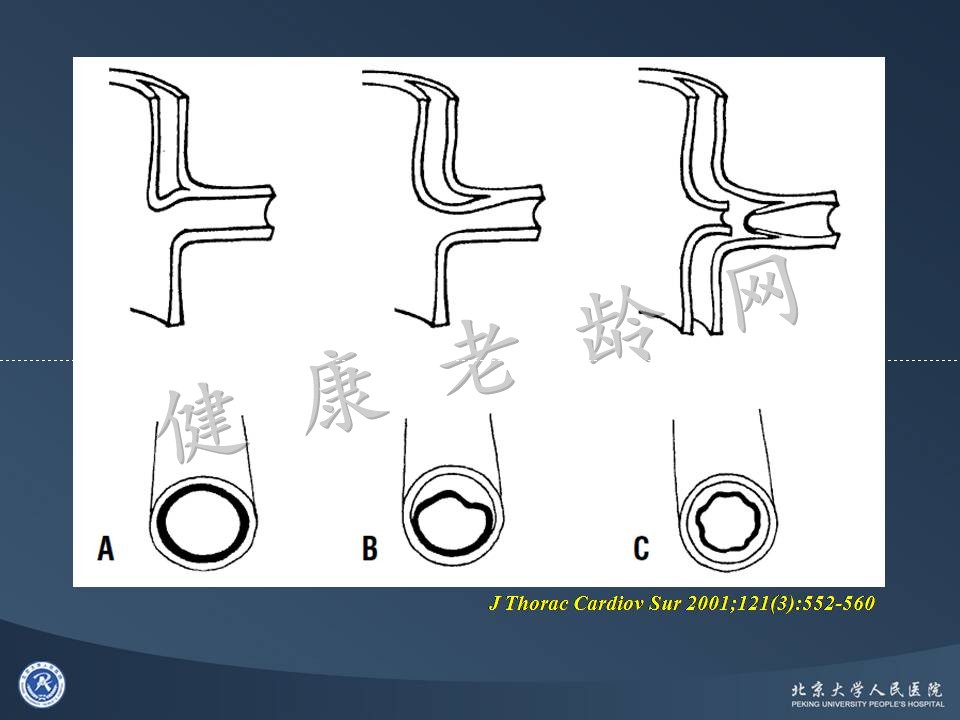 真实病因被忽视的急性心肌梗死