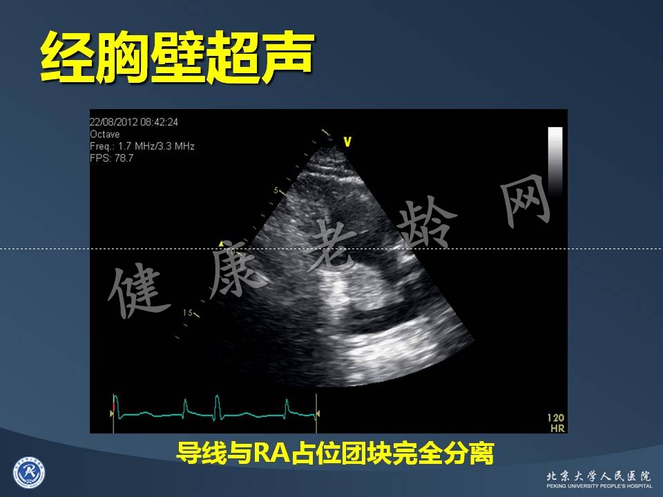 心房占位的诊断困境