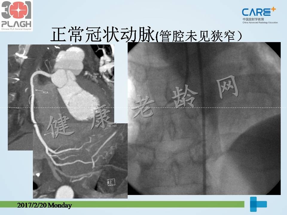 心脏、冠状动脉CT检查（CTA）：判读与意义