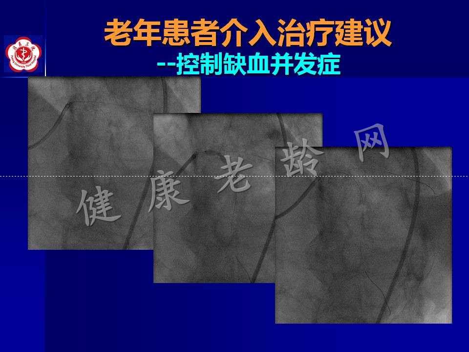 高龄冠心病患者介入治疗——问题思考