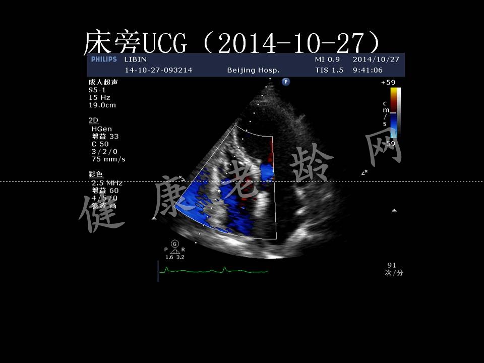 急性心肌梗后心脏破裂
