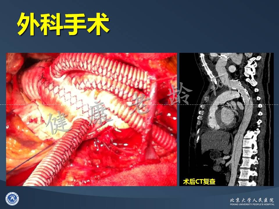 真实病因被忽视的急性心肌梗死