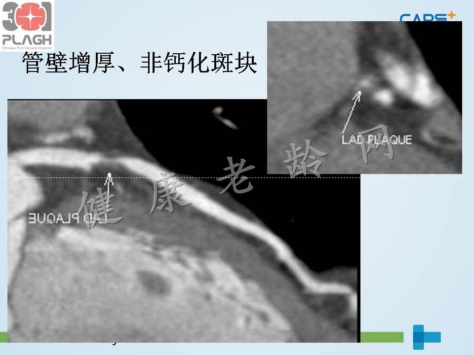 心脏、冠状动脉CT检查（CTA）：判读与意义