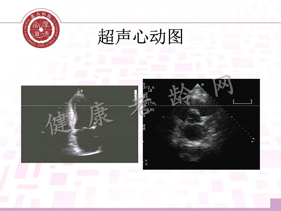 老年高血压、冠心病合并瓣膜病心力衰竭患者的治疗思路