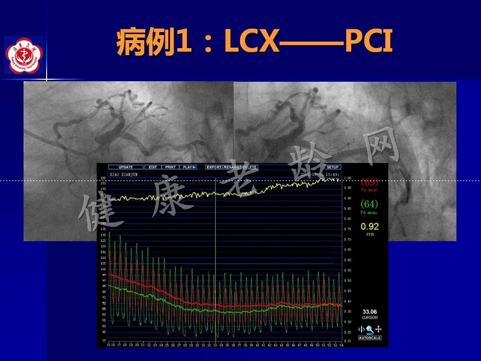 高龄冠心病患者介入治疗——问题思考