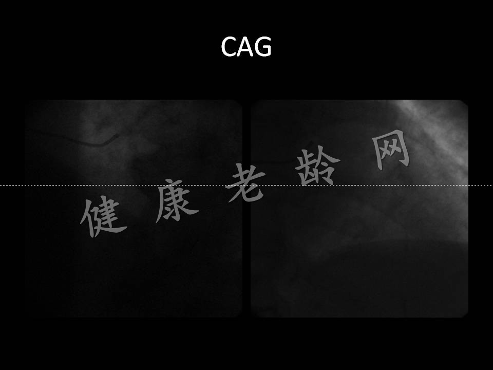 急性心肌梗后心脏破裂