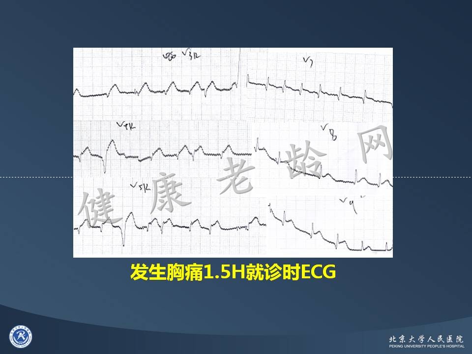 真实病因被忽视的急性心肌梗死