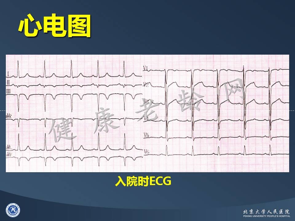 真实病因被忽视的急性心肌梗死