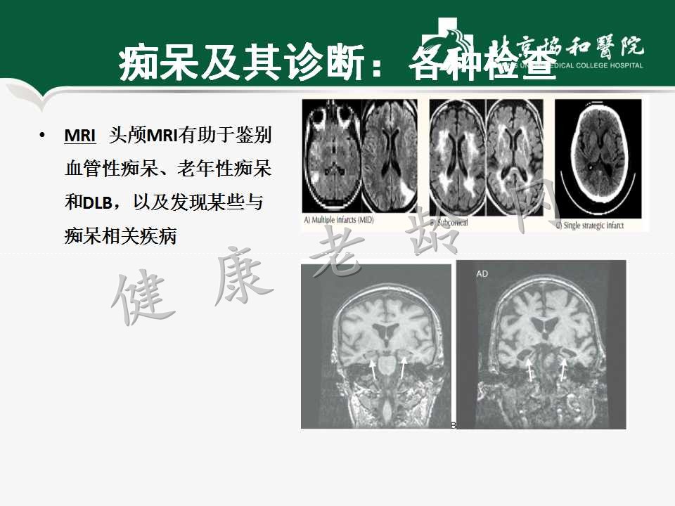 老年人认知障碍——痴呆的诊断和治疗