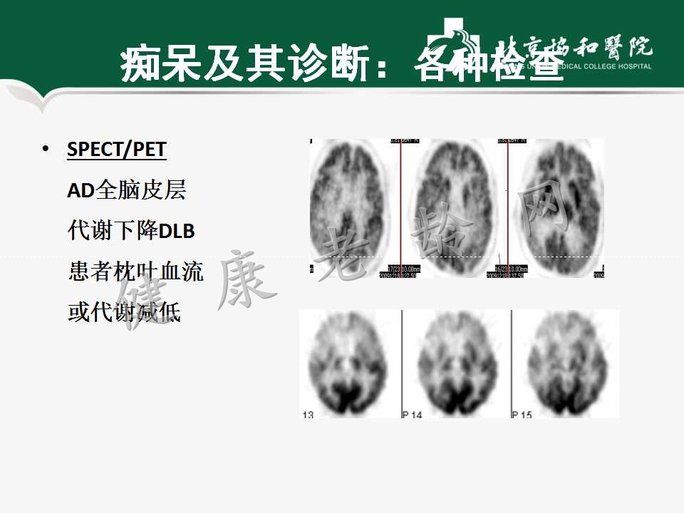 老年人认知障碍——痴呆的诊断和治疗