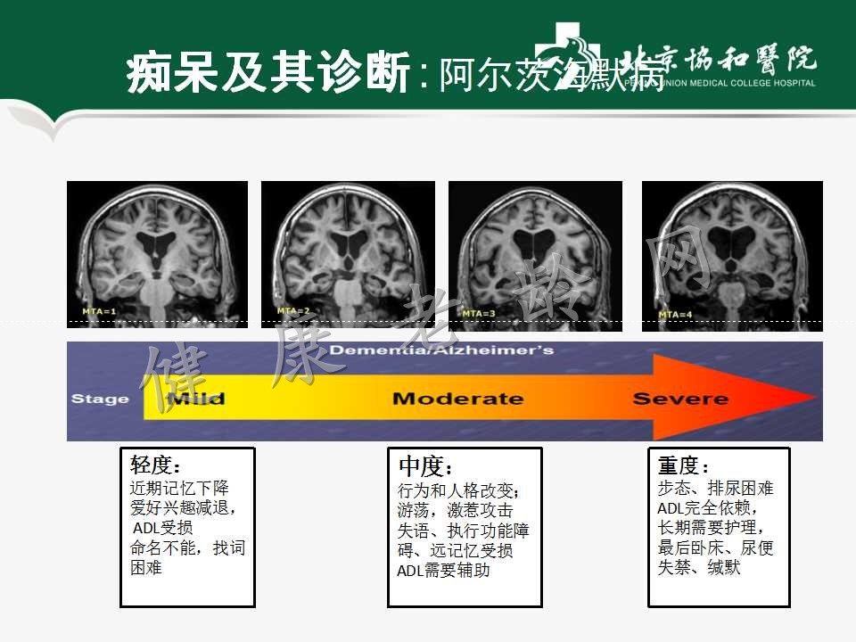 老年人认知障碍——痴呆的诊断和治疗