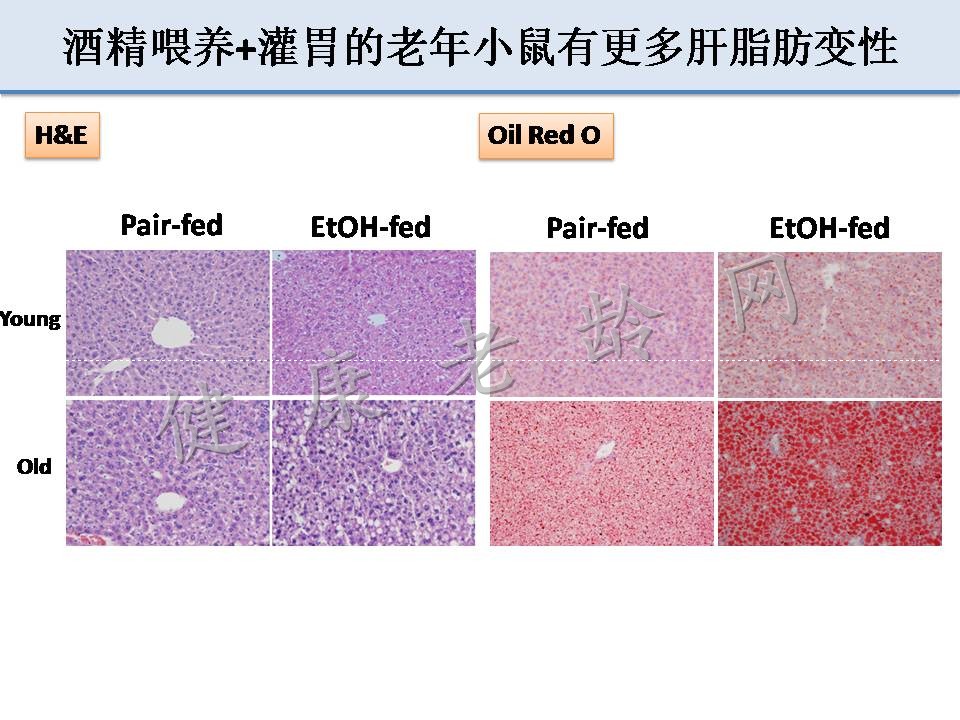 衰老加重酒精性肝损伤和前列腺炎症反应