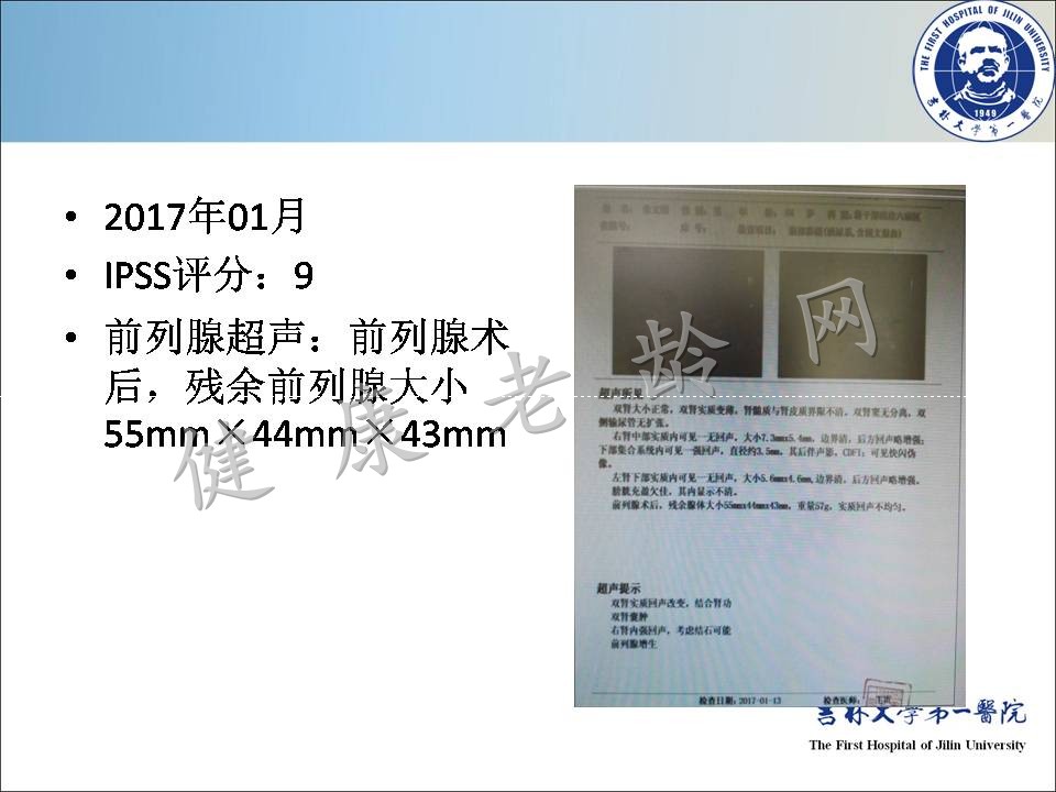 症状控制--LUTS诊疗新模式